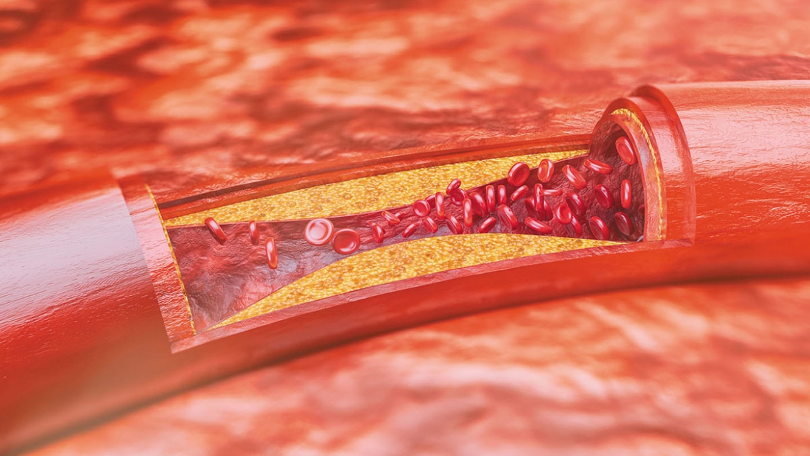 ARTHEROSCLEROSIS