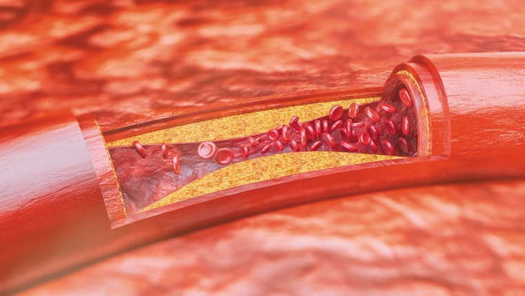 ARTHEROSCLEROSIS